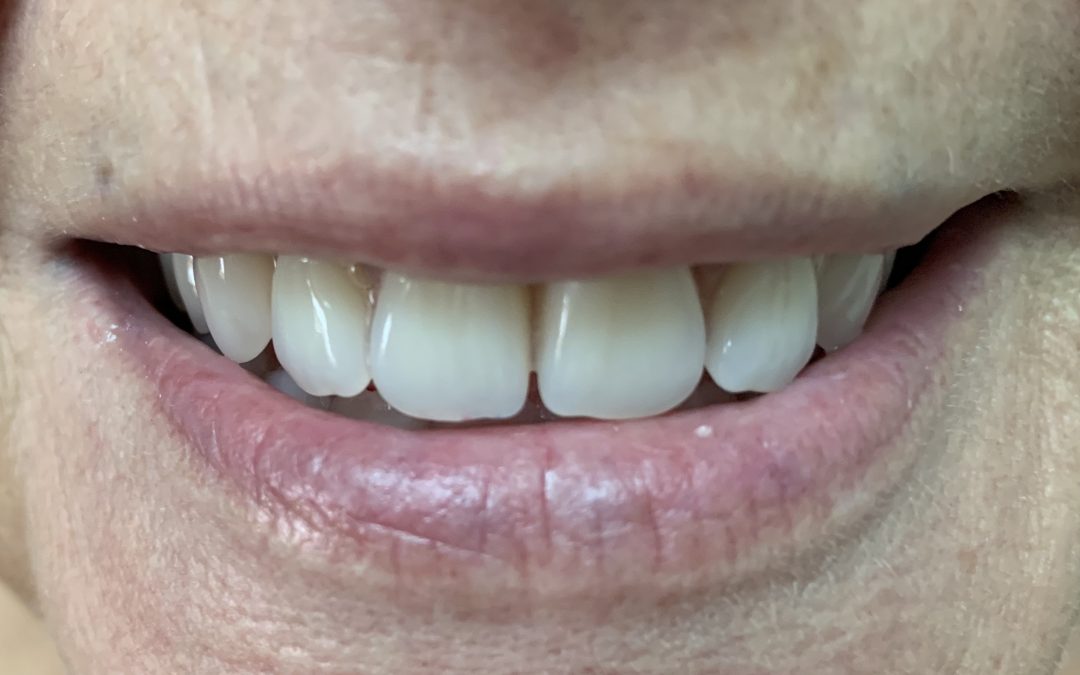Quatre conseils pour l’entretien de votre prothèse dentaire
